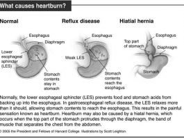 Getting rid of heartburn