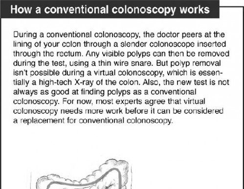 The reality of ‘virtual’ colonoscopy