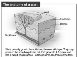 What to do about the worrisome wart