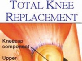 Knee replacement surgery a last option