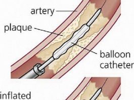 Angioplasty: Cardiovascular procedure widens clogged arteries, improves blood flow – without surgery