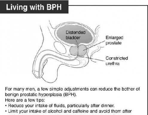 Living with benign prostatic hyperplasia