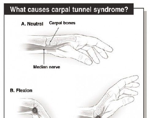 Carpal Tunnel Versus Repetitive Stress