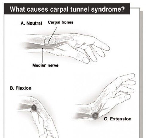 Carpal Tunnel Versus Repetitive Stress