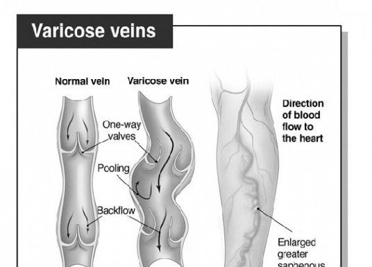 Varicose Surgery Not Done in Vein