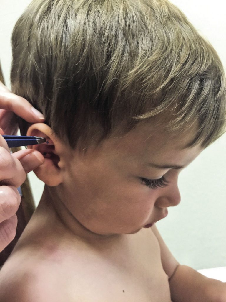 Healing children with acupuncture